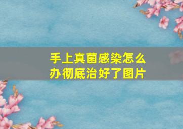 手上真菌感染怎么办彻底治好了图片