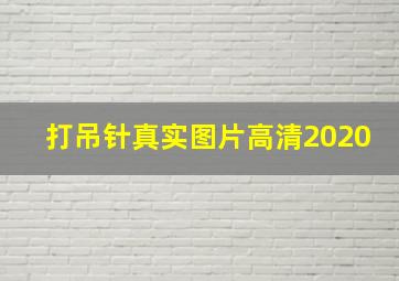 打吊针真实图片高清2020