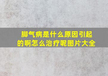 脚气病是什么原因引起的啊怎么治疗呢图片大全