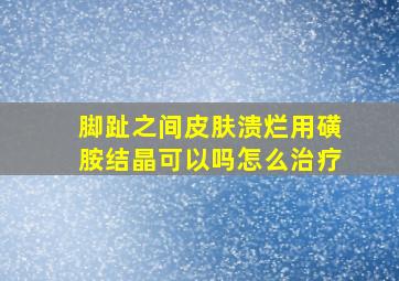 脚趾之间皮肤溃烂用磺胺结晶可以吗怎么治疗