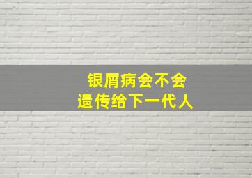 银屑病会不会遗传给下一代人