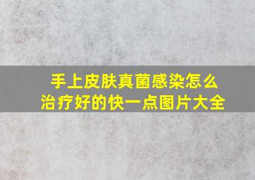 手上皮肤真菌感染怎么治疗好的快一点图片大全