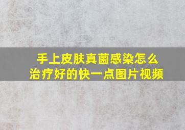 手上皮肤真菌感染怎么治疗好的快一点图片视频