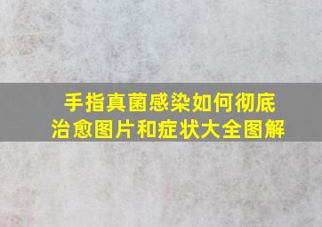 手指真菌感染如何彻底治愈图片和症状大全图解