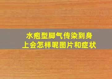 水疱型脚气传染到身上会怎样呢图片和症状