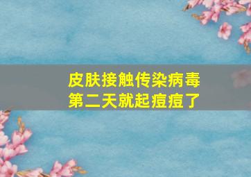 皮肤接触传染病毒第二天就起痘痘了