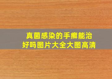 真菌感染的手癣能治好吗图片大全大图高清