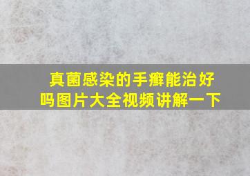 真菌感染的手癣能治好吗图片大全视频讲解一下