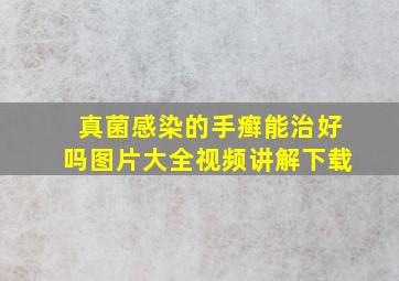 真菌感染的手癣能治好吗图片大全视频讲解下载