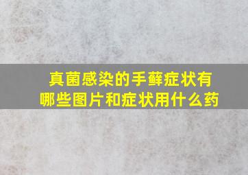 真菌感染的手藓症状有哪些图片和症状用什么药