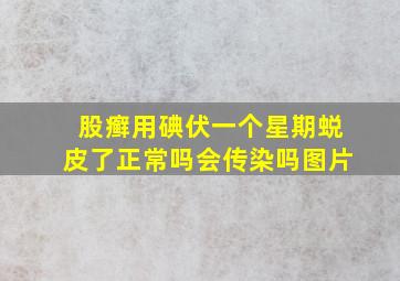 股癣用碘伏一个星期蜕皮了正常吗会传染吗图片