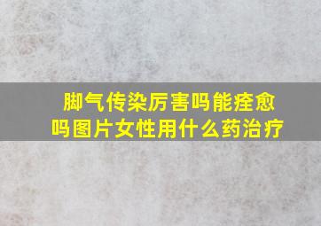 脚气传染厉害吗能痊愈吗图片女性用什么药治疗