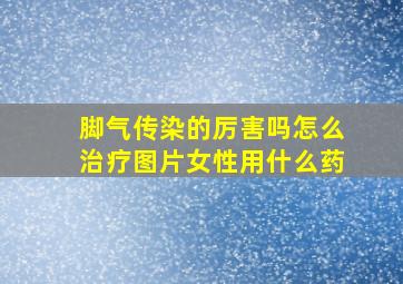 脚气传染的厉害吗怎么治疗图片女性用什么药