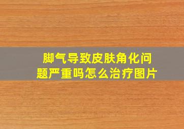 脚气导致皮肤角化问题严重吗怎么治疗图片