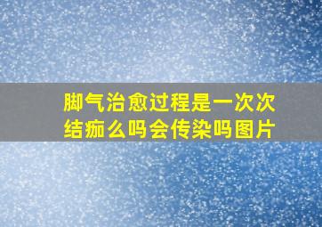 脚气治愈过程是一次次结痂么吗会传染吗图片