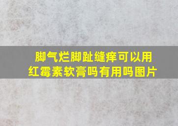 脚气烂脚趾缝痒可以用红霉素软膏吗有用吗图片