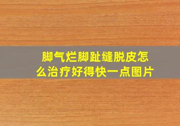 脚气烂脚趾缝脱皮怎么治疗好得快一点图片