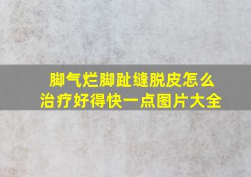 脚气烂脚趾缝脱皮怎么治疗好得快一点图片大全