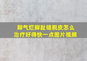 脚气烂脚趾缝脱皮怎么治疗好得快一点图片视频