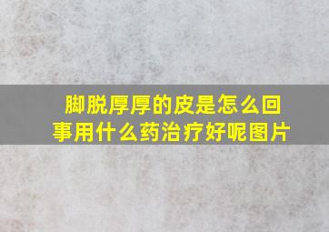 脚脱厚厚的皮是怎么回事用什么药治疗好呢图片