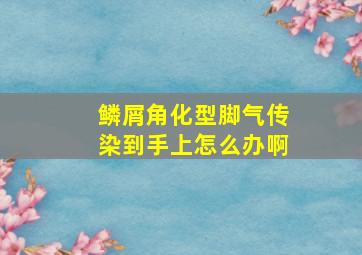 鳞屑角化型脚气传染到手上怎么办啊